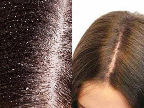 Полезные свойства уксуса для волос. способы применения яблочного уксуса для волос